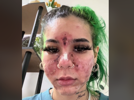A young woman with face burns